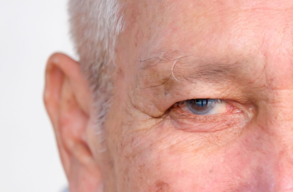 A close-up of a mature gentleman's eye showing their cataract.