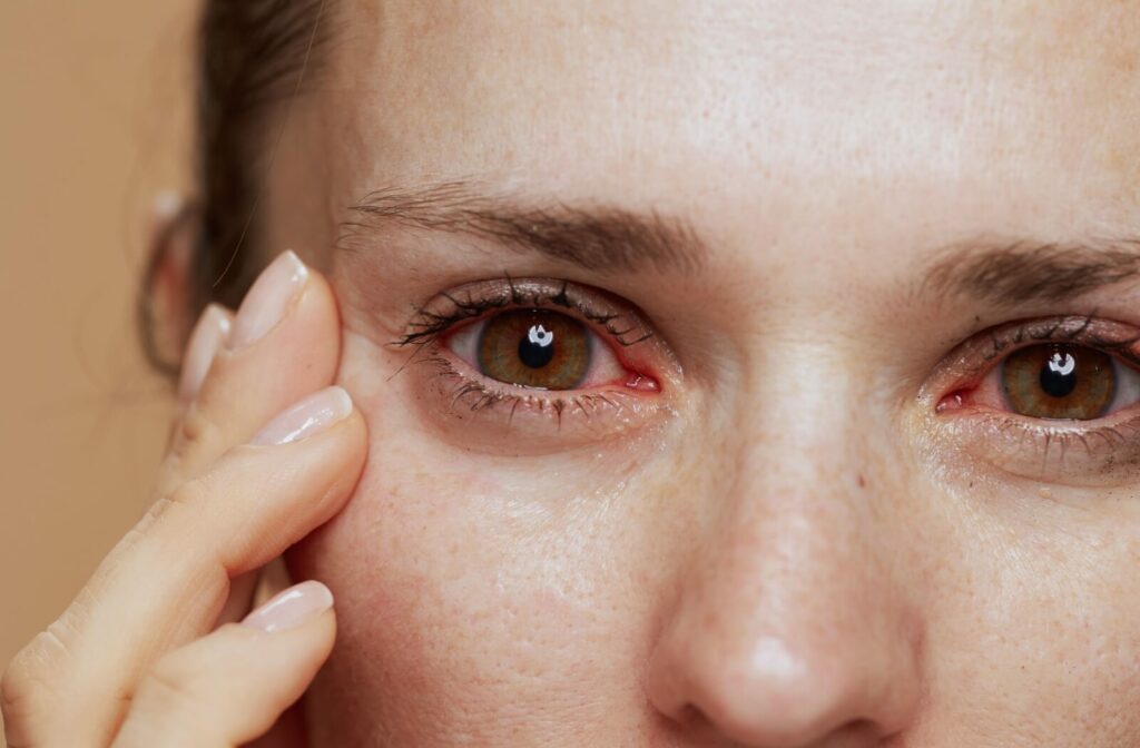 Close-up of a young woman’s eyes, which are red and irritated from dry eye symptoms