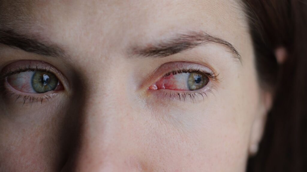 A close-up of the red irritated eyes of a woman suffering from dry eye syndrome.