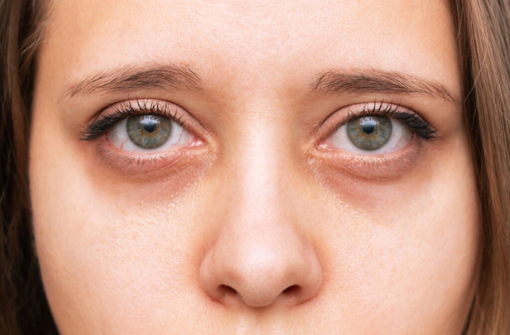 Close-up of a woman’s eyes showing redness and mild irritation around the lower eyelids.