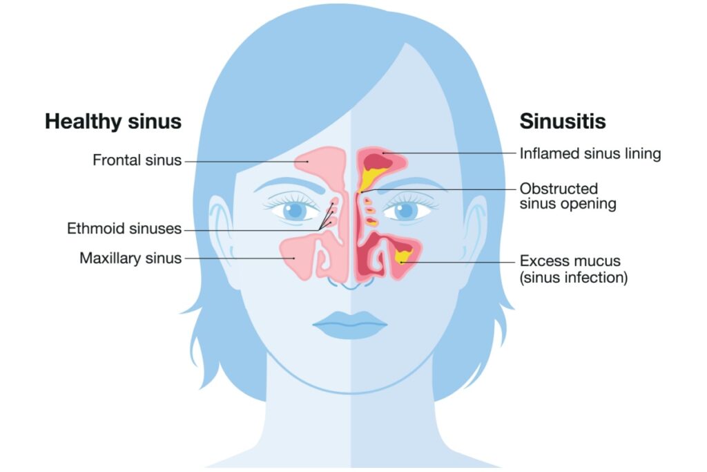 Medical illustration comparing healthy sinuses to sinusitis, showing inflammation, obstructed sinus openings, and excess mucus buildup in the frontal, ethmoid, and maxillary sinuses.