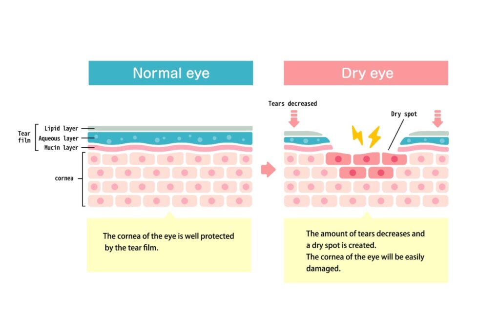 Illustrated cross section comparison between normal and dry eye tissue.