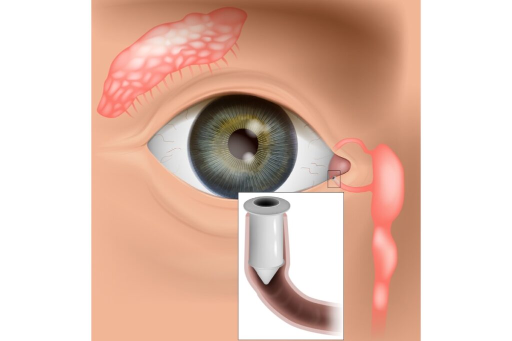 Illustration of punctal plugs.